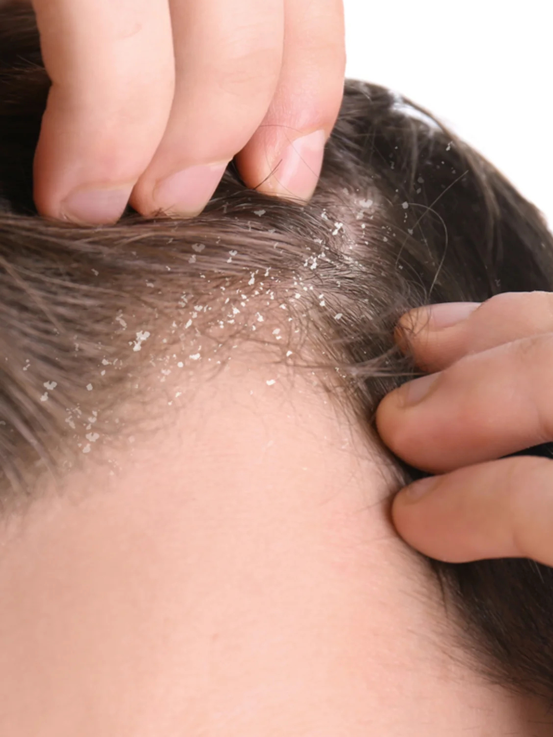 Dermatologist performing anti dandruff scalp treatment in Chennai to reduce dandruff, itching and scalp flakes at Anucare Aesthetic & Wellness Centre.