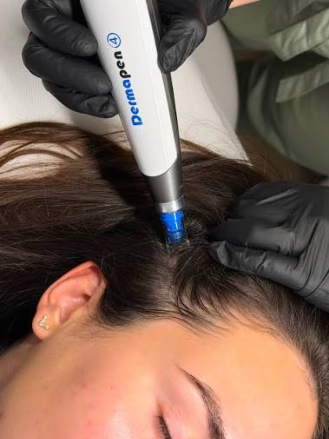 Dermapen 4 Hair Treatment in Chennai using advanced scalp microneedling to stimulate hair follicles, reduce hair thinning and promote natural hair growth at Anucare Aesthetic & Wellness Centre.