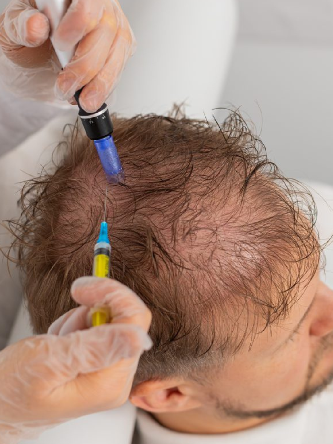 Hair Mesotherapy treatment in Chennai using scalp microinjections to reduce hair fall and promote healthy hair growth at Anucare Aesthetic & Wellness Centre.